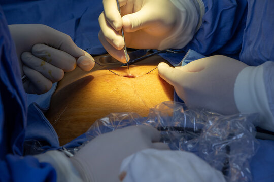 Cirug&iacute;a laparosc&oacute;pica 