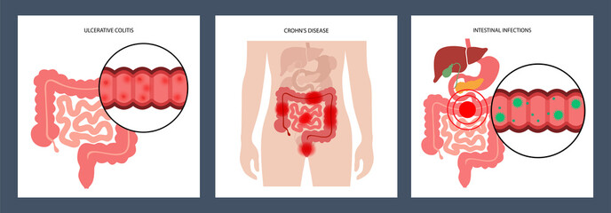 Intestines diseases concept