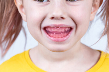 Six-year old caucasian girl shows myofunctional trainer in her mouth