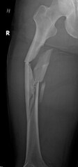 A bone x-ray of a comminuted  fractured femur
