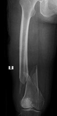 Fototapeta na wymiar A bone x-ray of a comminuted fractured femur 