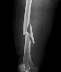 A bone x-ray of a comminuted  fractured femur

