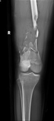 A bone x-ray of a comminuted  fractured femur
