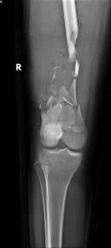 A bone x-ray of a comminuted  fractured femur
