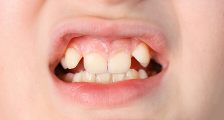 Close-up of a child's mouth with misaligned teeth, a dental problem.