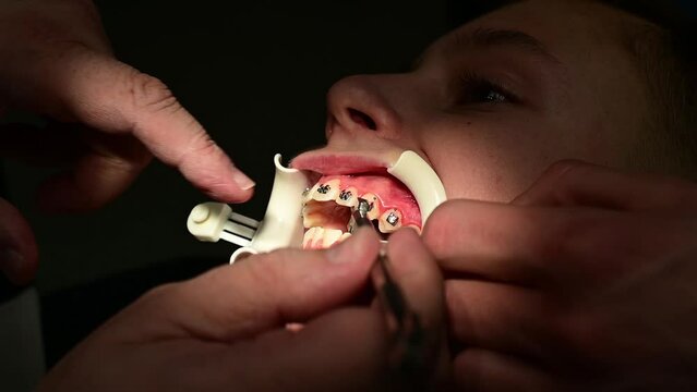 Installation of braces on the crooked teeth of the child, a white retractor on the lips to facilitate the work of the orthodontist.