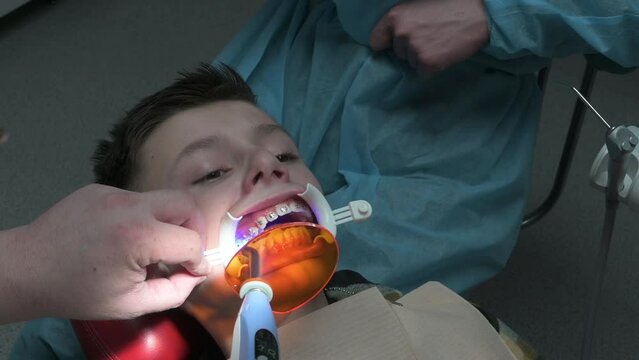 The use of ultraviolet light during the installation of braces, braces on the upper jaw crooked teeth.