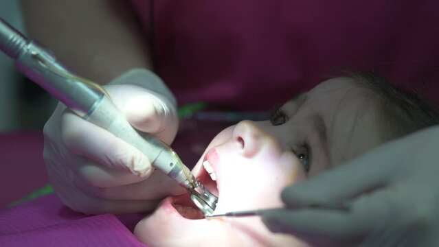 Treatment of baby teeth in a child, a doctor drills a tooth for caries.