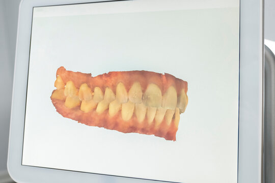 Scanned image of teeth on monitor screen at dental clinic