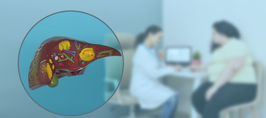 Liver problems in overweight people. Anatomical model of human liver showing liver disease,...