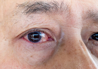A person with a red inflamed watery eye caused by bacterial infection or a severe reaction of hay...