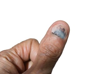 Close up of Subungual Hematoma on thumb nail.
