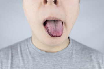 Black tongue. A man shows the consequences of an injury, bite or burn of the tongue. Part is damaged. Treatment of internal injuries
