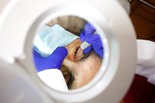 Middle aged male client during laser treatment in a medical aesthetic clinic