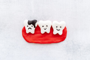 Teeth models with caries or plaque on gums. Oral health concept