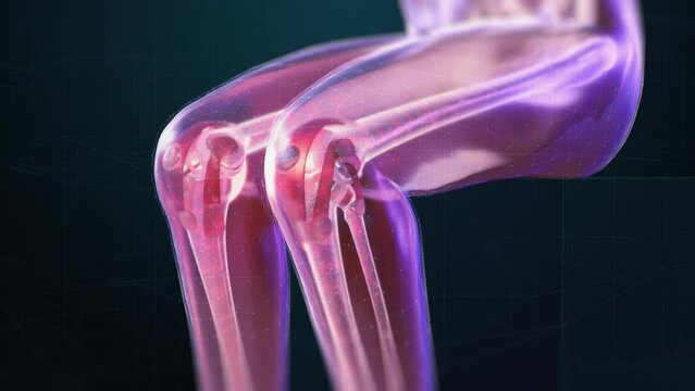VFX Joint and Knee Pain Virtual Reality Presentation Render. Animated Person Experiencing Discomfort in a Result of Leg Trauma or Arthritis. Schematic Medical Visualization.
