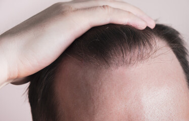 Hair loss problem. Man shows hairline on the head. Baldness treatment concept, genetic alopecia....