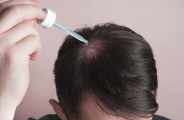 Hair loss problem. Man applying dropper with minoxidil or serum. Baldness treatment concept,...