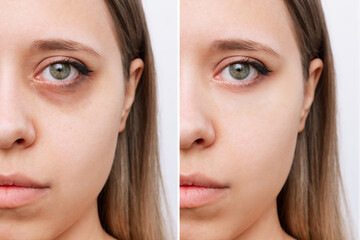 Cropped shot of young caucasian woman's face with dark circles under eyes before and after cosmetic...