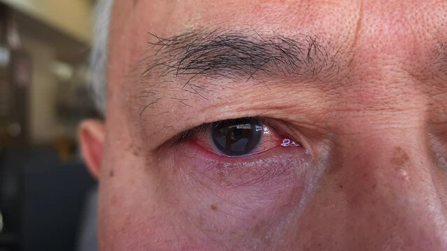 A person with a red inflamed watery eye caused by bacterial infection or a severe reaction of hay fever.