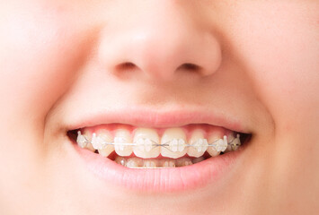 smiling mouth with dental aligner