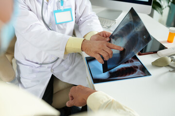 Hands of plmonologis pointing at lungs x-rays when explaining patient that he has tumor