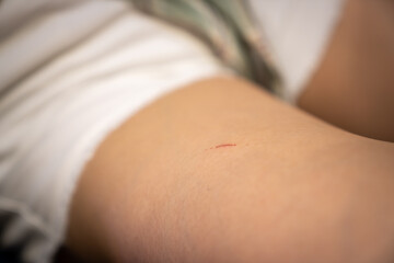 A bleeding wound on a broken skin