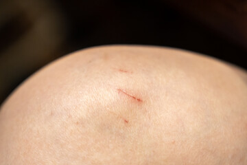 Fototapeta premium A bleeding wound on a broken skin