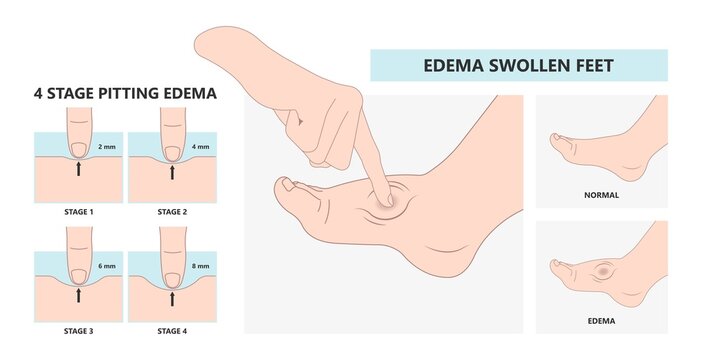 cloth blood feet ankle syndrome Milroy Leg edema venous Deep vein cancer swelling upper limb wrap calf ulcer meige lymph node arms hand pain liver kidney heart lung non Nonpitting pedal