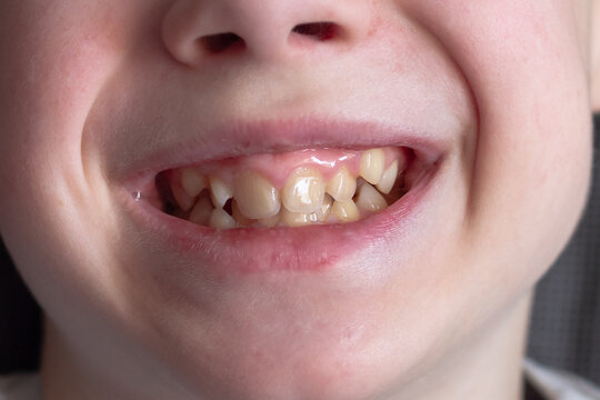 A European boy shows uneven crooked teeth