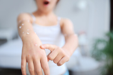 Little girl ill with chickenpox  at home, closeup