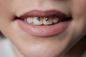 smile or frenulum piercing under the upper lip.