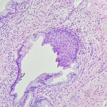 Camera photo of high-grade squamous intraepithelial lesion (HSIL), involving endocervical gland, magnification 200x, photograph through a microscope