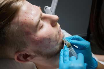 Injection at spa salon. Doctor hands in gloves. Closeup. Pretty male patient. Beauty treatment....