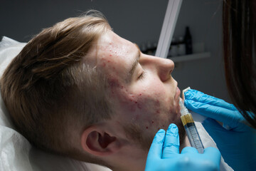 Injection at spa salon. Doctor hands in gloves. Closeup. Pretty male patient. Beauty treatment....