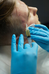 Injection at spa salon. Doctor hands in gloves. Closeup. Pretty male patient. Beauty treatment....