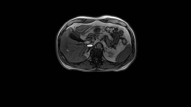CT scan of the abdomen. Computed tomography of the gastrointestinal tract, liver and kidneys.