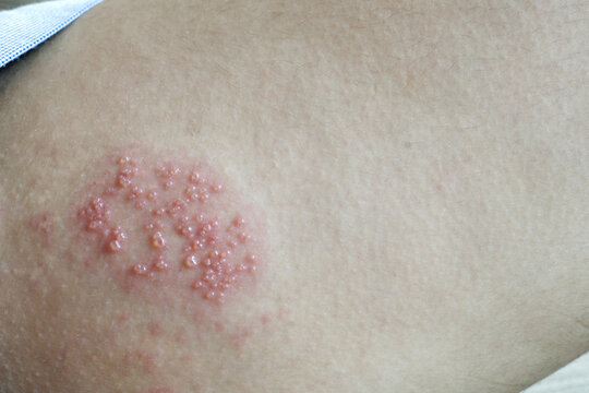 Shingles Rash Images – Browse 2,101 Stock Photos, Vectors, and Video ...