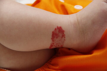 Infant hemangioma on the leg of a little boy