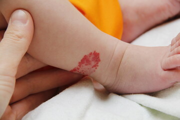 Infant hemangioma on the leg of a little boy