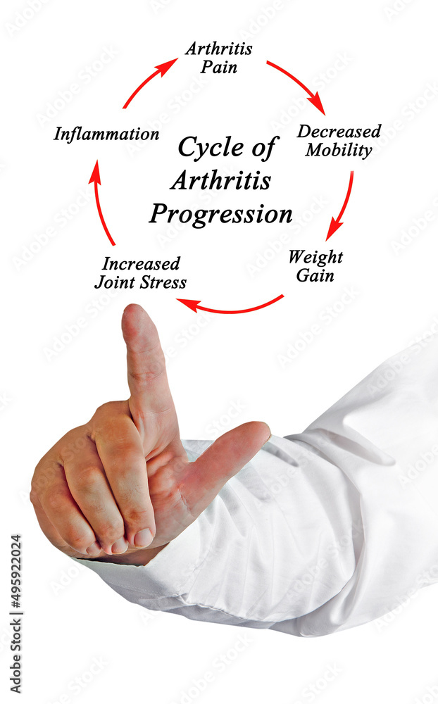 Sticker Steps in Cycle of Arthritis Progression.