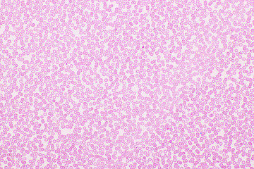 Red blood cells in blood smear, Wright-Giemsa stain, analyze by microscope, 40x