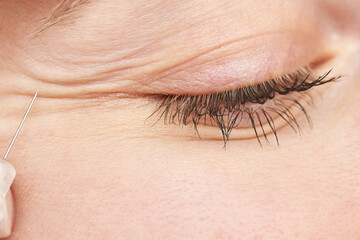 Injection at spa salon. Doctor hands in gloves. Closeup. Pretty female patient. Beauty treatment. Healthy skin procedure. Young women face. Plasmolifting rejuvenation