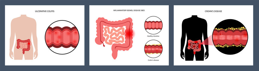 Intestines diseases concept