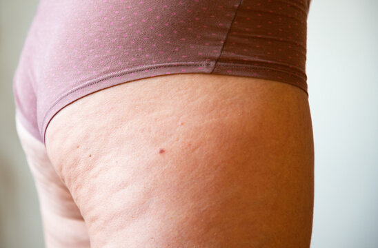 cellulite or orange crust on  feet. Reducing overweight and struggle with cellulite, subcutaneous fat deposition