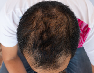 Top view of Asian male pattern baldness. Hair loss (alopecia) can affect just your scalp or your...