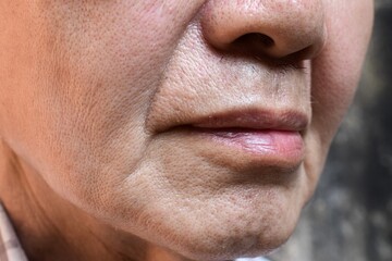 Enlarged pores in face of Asian, elder man with skin folds.
