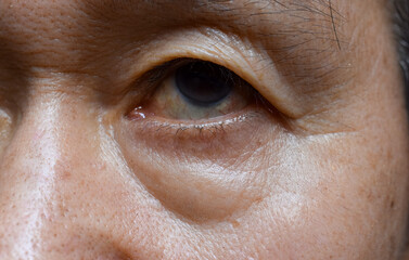 Prominent fat bag and wrinkles under eye of Asian elder man.