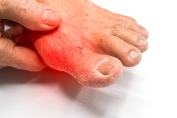 Inflammation of Asian man’s foot. Concept of foot joint pain, stumble, arthritis, hyperuricema or...