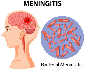 Diagram showing meningitis on human - obrazy, fototapety, plakaty